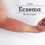 Homeopathy Treatment & Remedies For Eczema