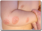 Best eczema homeopathic treatment, remedies, doctor, clinic in Sunnyvale